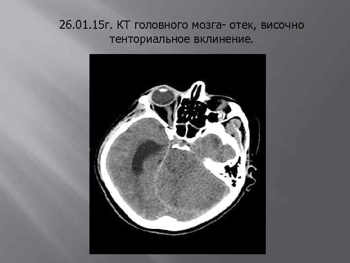 26. 01. 15 г. КТ головного мозга- отек, височно тенториальное вклинение. 