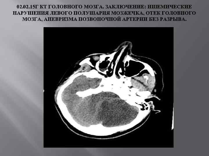 02. 15 Г КТ ГОЛОВНОГО МОЗГА. ЗАКЛЮЧЕНИЕ: ИШЕМИЧЕСКИЕ НАРУШЕНИЯ ЛЕВОГО ПОЛУШАРИЯ МОЗЖЕЧКА, ОТЕК ГОЛОВНОГО