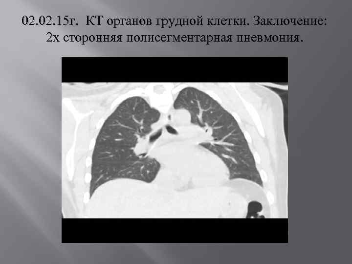 Картина двусторонней полисегментарной пневмонии кт