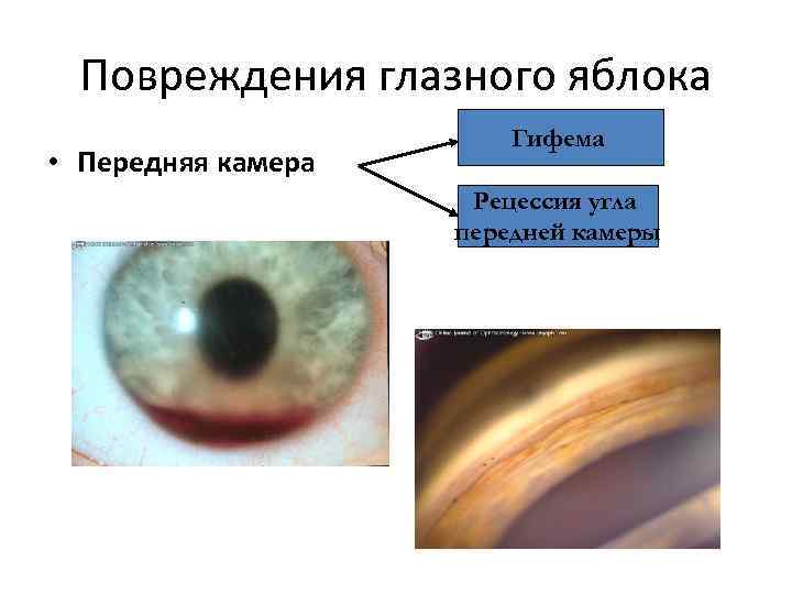 Повреждения глазного яблока • Передняя камера Гифема Рецессия угла передней камеры 