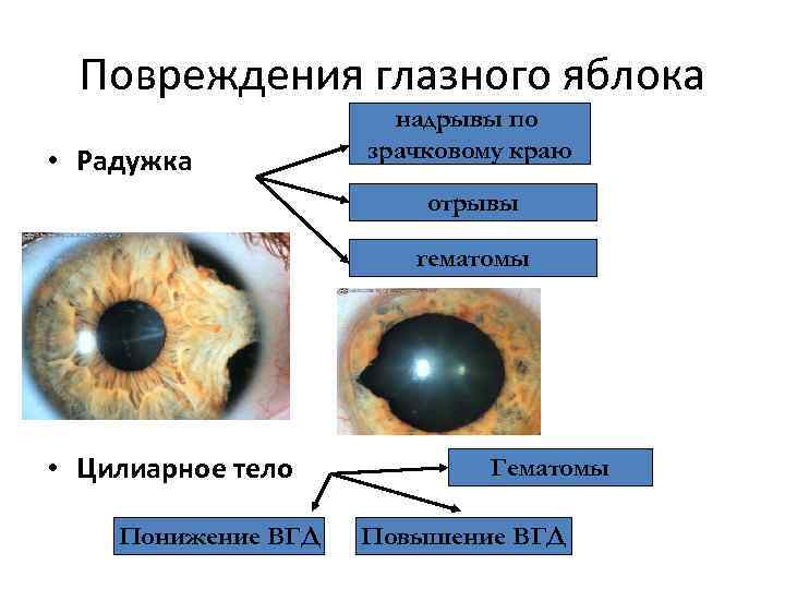 Повреждения глазного яблока • Радужка надрывы по зрачковому краю отрывы гематомы • Цилиарное тело