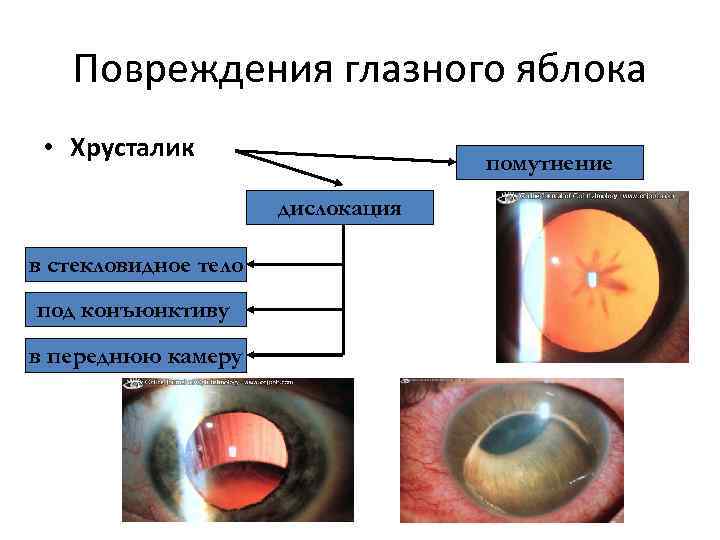 Повреждения глазного яблока • Хрусталик помутнение дислокация в стекловидное тело под конъюнктиву в переднюю