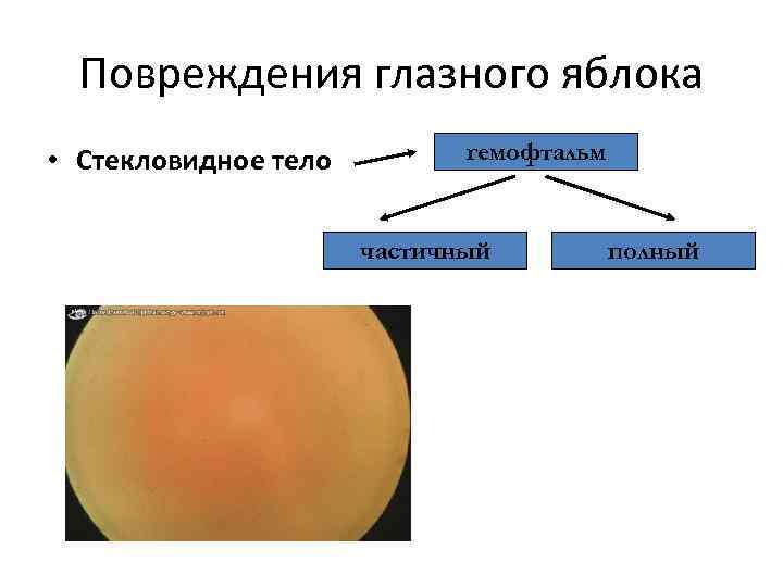 Повреждения глазного яблока • Стекловидное тело гемофтальм частичный полный 