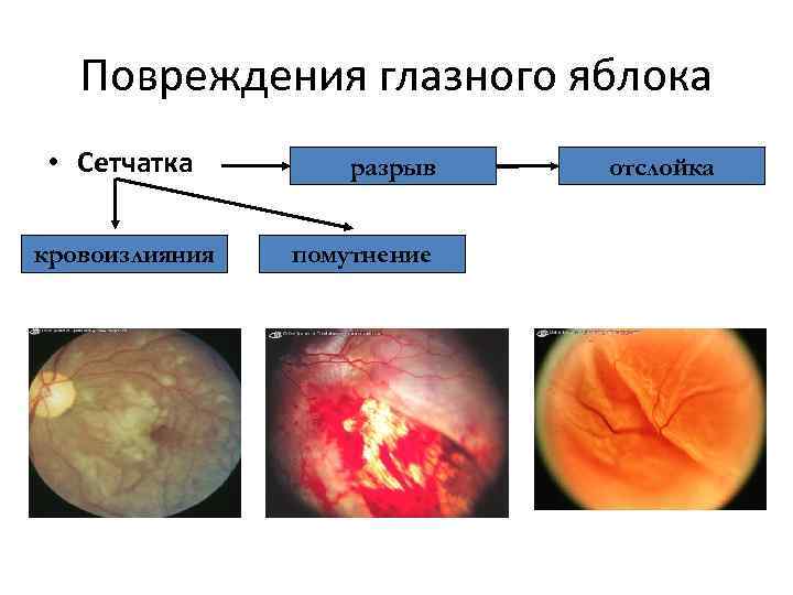 Повреждения глазного яблока • Сетчатка кровоизлияния разрыв помутнение отслойка 