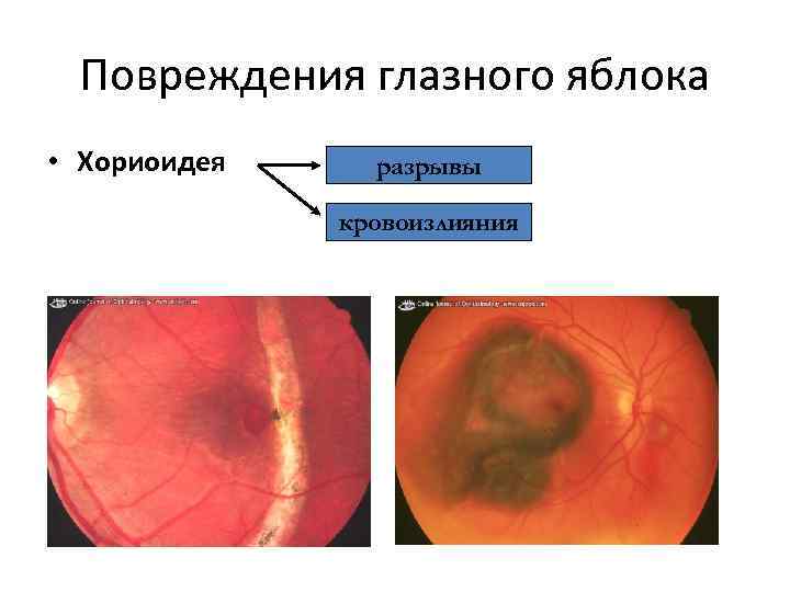 Повреждения глазного яблока • Хориоидея разрывы кровоизлияния 