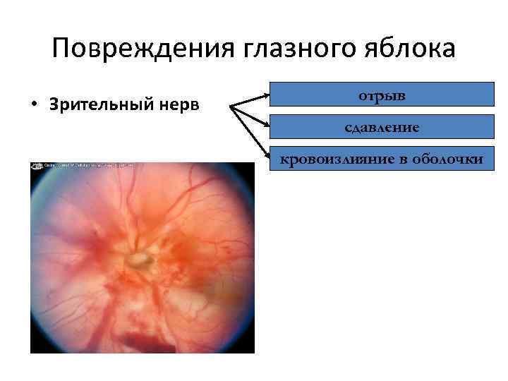 Повреждения глазного яблока • Зрительный нерв отрыв сдавление кровоизлияние в оболочки 