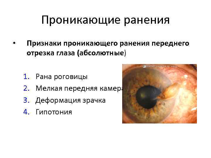 Проникающие ранения • Признаки проникающего ранения переднего отрезка глаза (абсолютные) 1. 2. 3. 4.