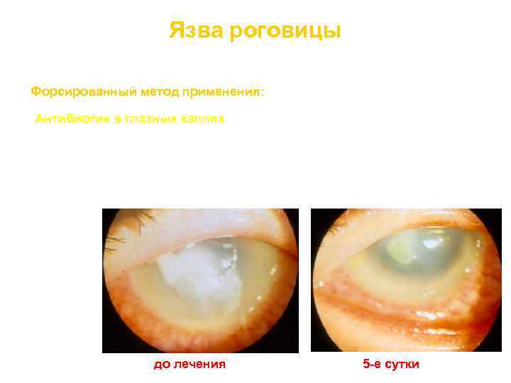 Язва роговицы возбудитель – синегнойная палочка Форсированный метод применения: Антибиотик в глазных каплях -
