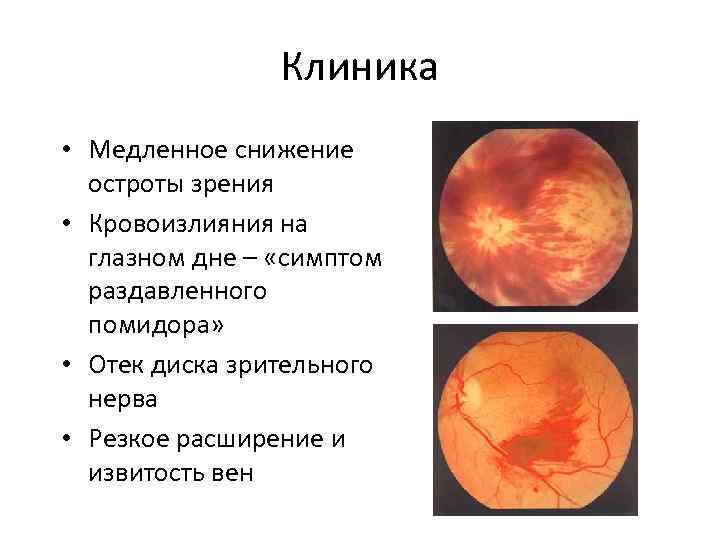 Клиника • Медленное снижение остроты зрения • Кровоизлияния на глазном дне – «симптом раздавленного