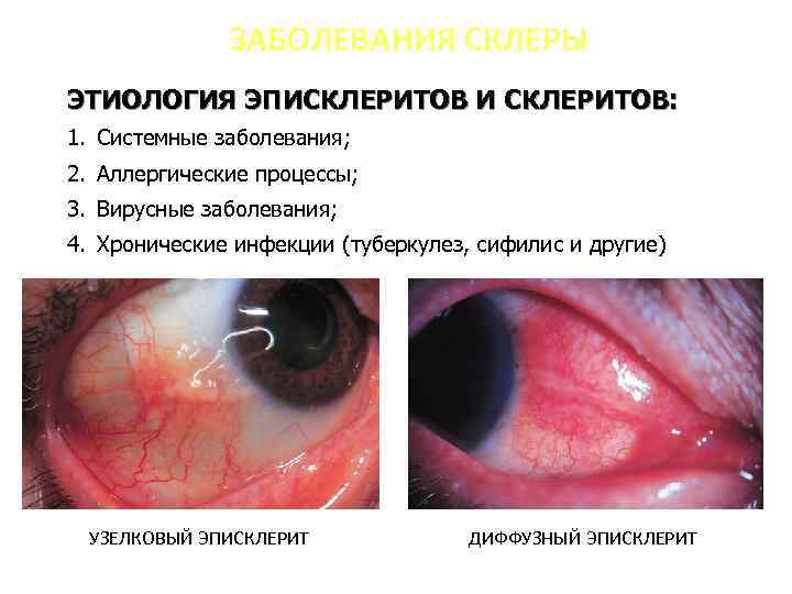 ЗАБОЛЕВАНИЯ СКЛЕРЫ ЭТИОЛОГИЯ ЭПИСКЛЕРИТОВ И СКЛЕРИТОВ: 1. Системные заболевания; 2. Аллергические процессы; 3. Вирусные