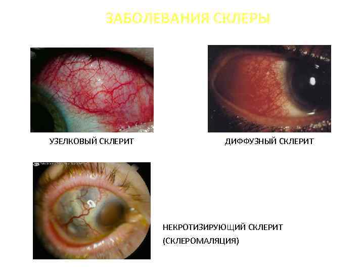 ЗАБОЛЕВАНИЯ СКЛЕРЫ УЗЕЛКОВЫЙ СКЛЕРИТ ДИФФУЗНЫЙ СКЛЕРИТ НЕКРОТИЗИРУЮЩИЙ СКЛЕРИТ (СКЛЕРОМАЛЯЦИЯ) 