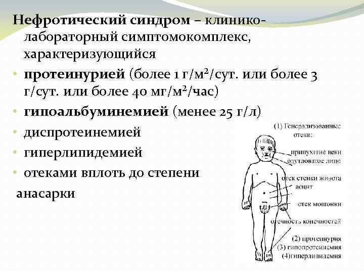 Нефротический синдром – клиниколабораторный симптомокомплекс, характеризующийся • протеинурией (более 1 г/м²/сут. или более 3