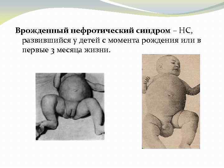 Врожденный нефротический синдром – НС, развившийся у детей с момента рождения или в первые