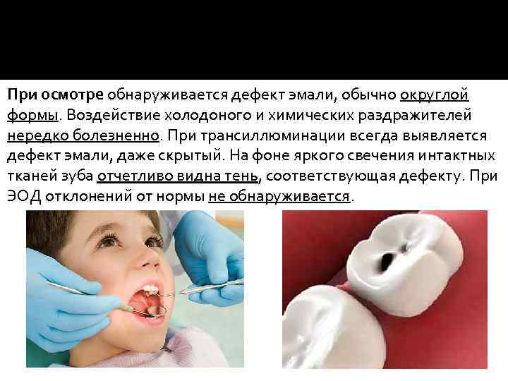 При осмотре обнаруживается дефект эмали, обычно округлой формы. Воздействие холодоного и химических раздражителей нередко