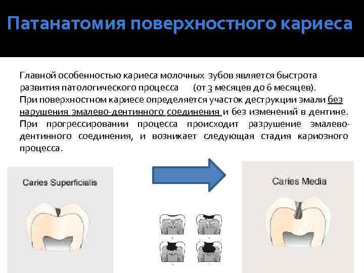 Патанатомия поверхностного кариеса Главной особенностью кариеса молочных зубов является быстрота развития патологического процесса (от