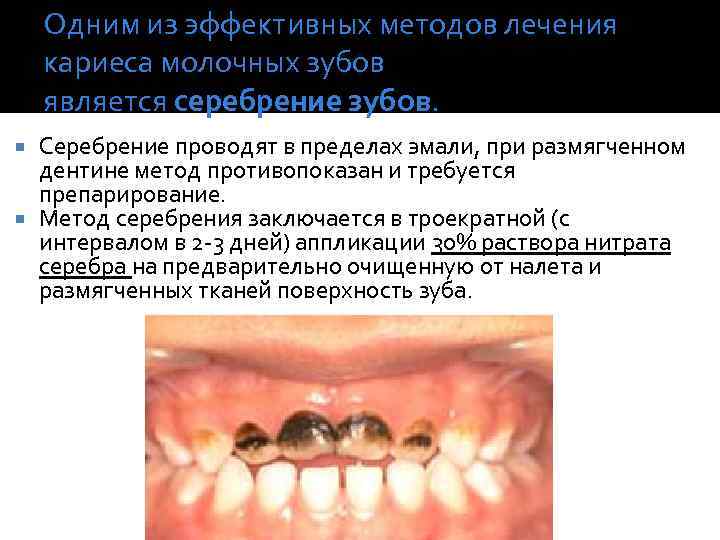Одним из эффективных методов лечения кариеса молочных зубов является серебрение зубов. Серебрение проводят в