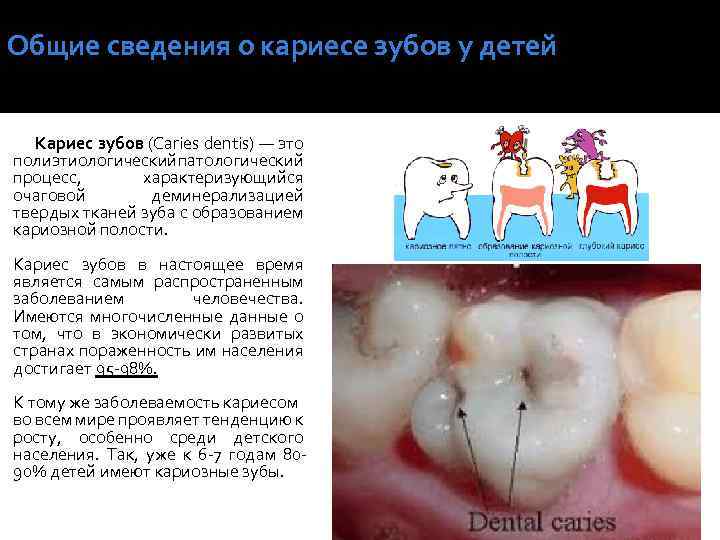 Общие сведения о кариесе зубов у детей Кариес зубов (Caries dentis) — это полиэтиологический