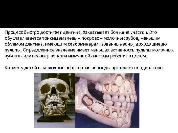 Кариес у детей в различные возрастные периоды протекает неодинаково. Главной особенностью кариеса молочных зубов