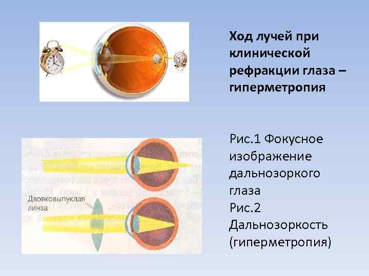 Рефракция при дальнозоркости. При гиперметропии. Классификация гиперметропии. Рефракция глаза. Рефракция линзы.