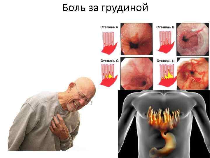 Боль за грудиной 