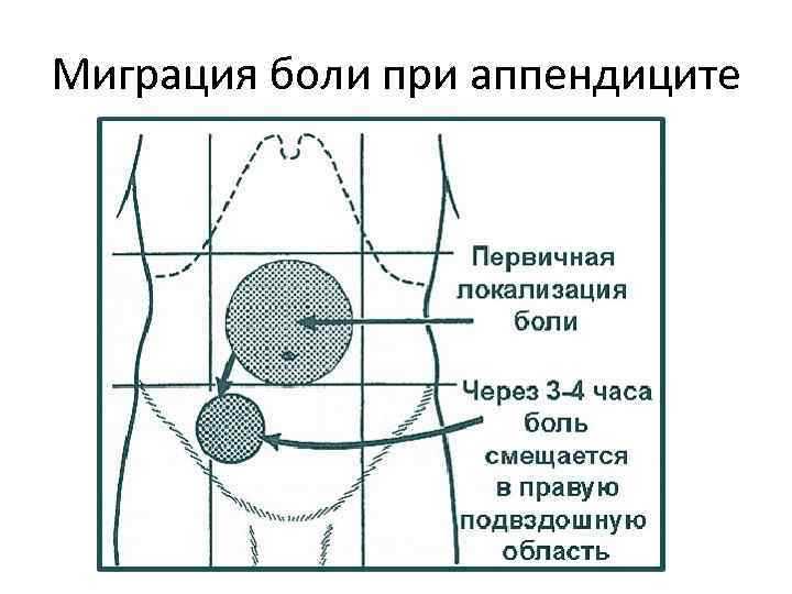 Место где болит при аппендиците на картинке