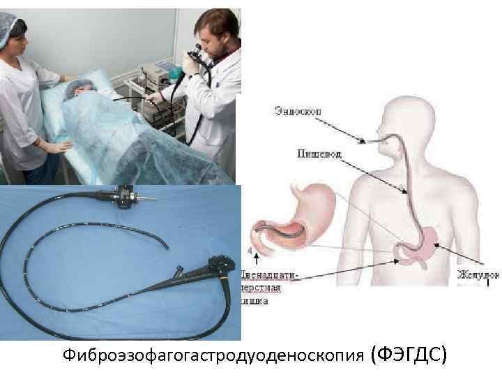 Фиброэзофагогастродуоденоскопия (ФЭГДС) 