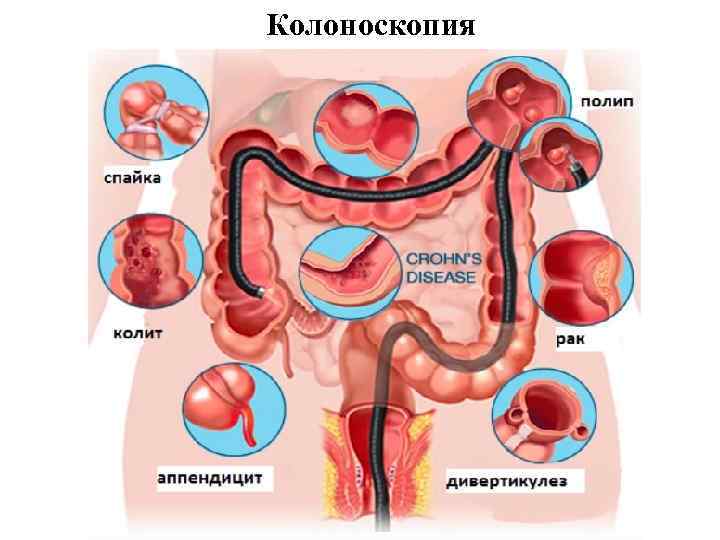 Колоноскопия 