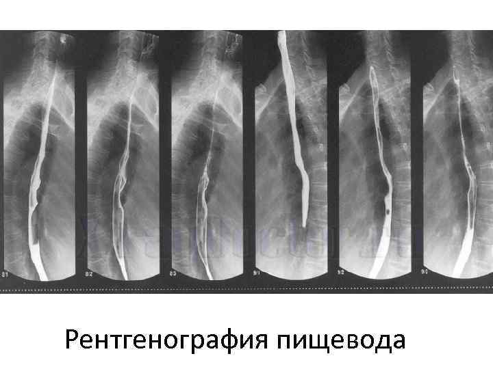 Рентгенография пищевода 