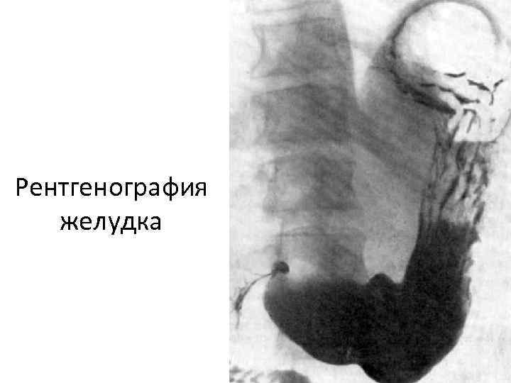 Рентгенография желудка 