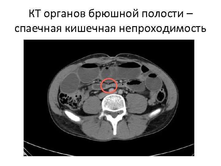 КТ органов брюшной полости – спаечная кишечная непроходимость 