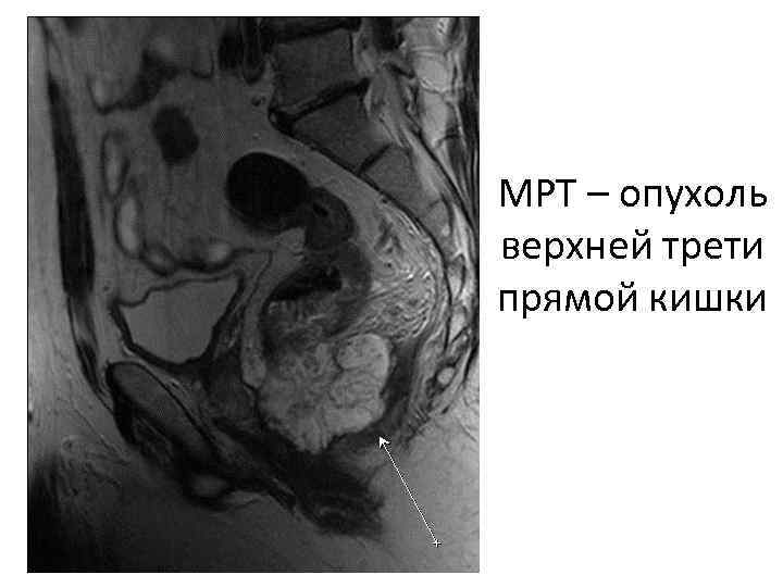 МРТ – опухоль верхней трети прямой кишки 