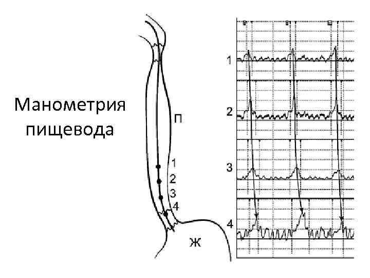 Манометрия сфинктера. Ахалазия кардии манометрия. Манометрия высокого разрешения пищевода. Поэтажная манометрия верхних отделов ЖКТ. Манометрия метод.