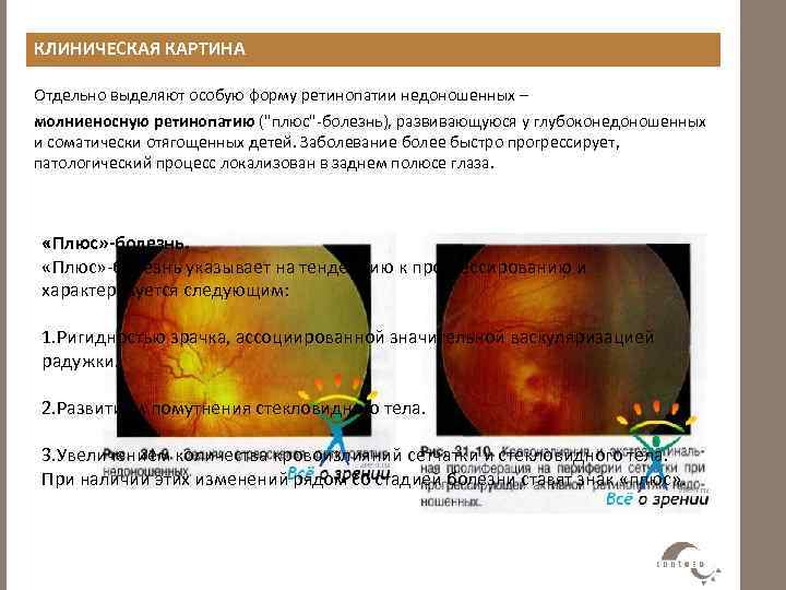 Ретинопатия недоношенных презентация