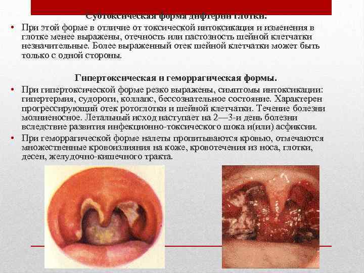 Субтоксическая форма дифтерии глотки. • При этой форме в отличие от токсической интоксикация и