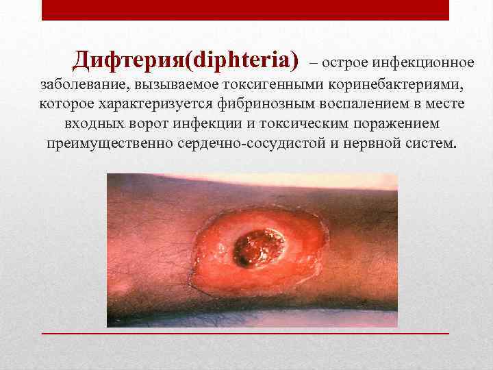 Дифтерия(diphteria) – острое инфекционное заболевание, вызываемое токсигенными коринебактериями, которое характеризуется фибринозным воспалением в месте