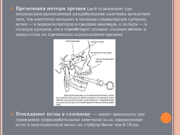  Временная потеря зрения (до 6 ч) возникает при неправильно выполненной мандибулярной анестезии вследствие