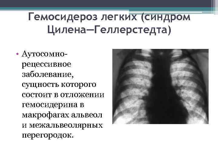 Гемосидероз легких (синдром Цилена—Геллерстедта) • Аутосомнорецессивное заболевание, сущность которого состоит в отложении гемосидерина в