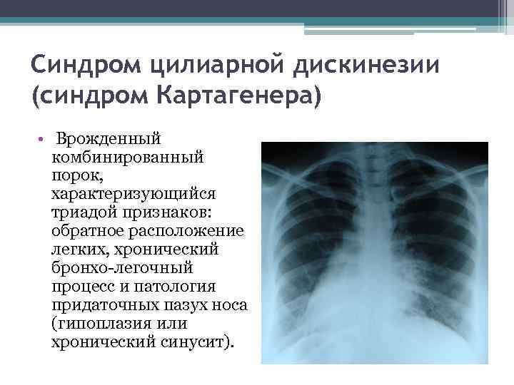 Синдром цилиарной дискинезии (синдром Картагенера) • Врожденный комбинированный порок, характеризующийся триадой признаков: обратное расположение