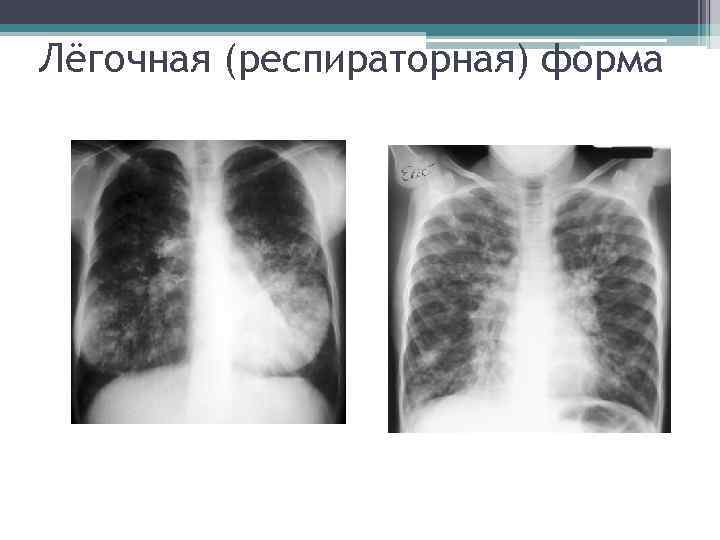 Лёгочная (респираторная) форма 