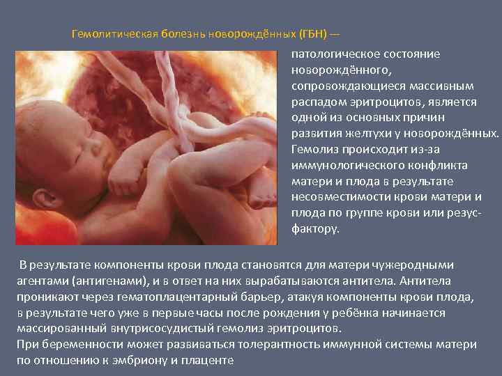 Гемолитическая болезнь новорождённых (ГБН) — патологическое состояние новорождённого, сопровождающиеся массивным распадом эритроцитов, является одной