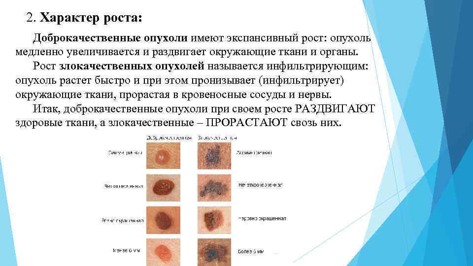 2. Характер роста: Доброкачественные опухоли имеют экспансивный рост: опухоль медленно увеличивается и раздвигает окружающие