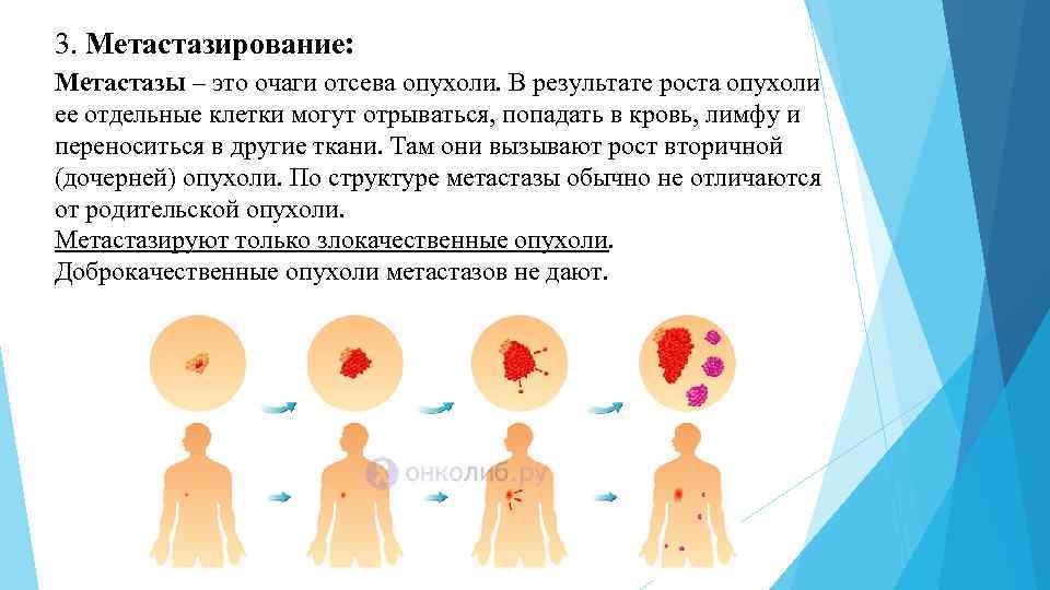 3. Метастазирование: Метастазы – это очаги отсева опухоли. В результате роста опухоли ее отдельные