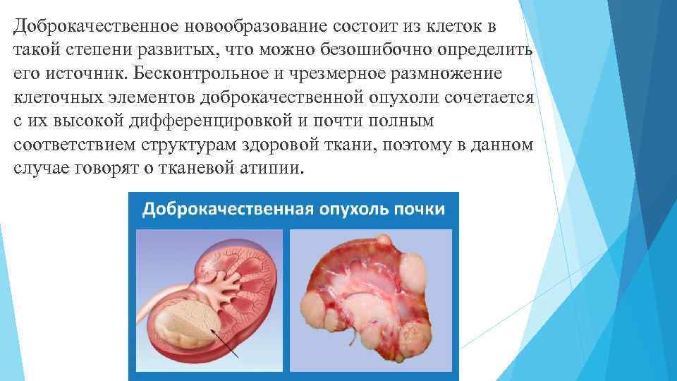 Доброкачественное новообразование состоит из клеток в такой степени развитых, что можно безошибочно определить его