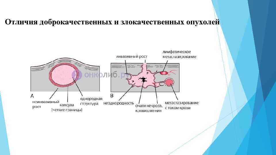 Отличия доброкачественных и злокачественных опухолей 