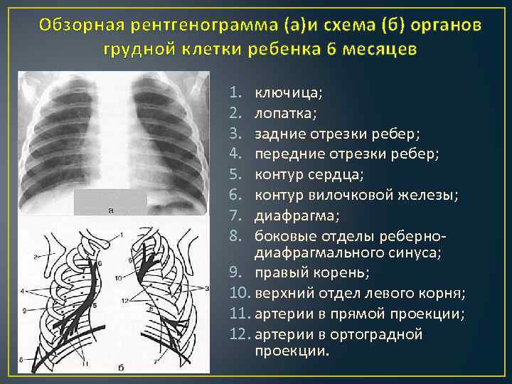 Обзорная рентгенограмма (а)и схема (б) органов грудной клетки ребенка 6 месяцев 1. 2. 3.