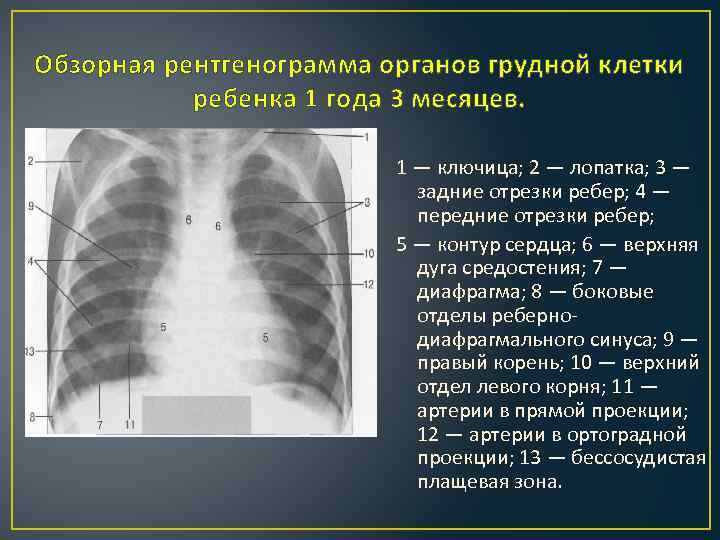 Обзорная рентгенограмма органов грудной клетки ребенка 1 года 3 месяцев. 1 — ключица; 2