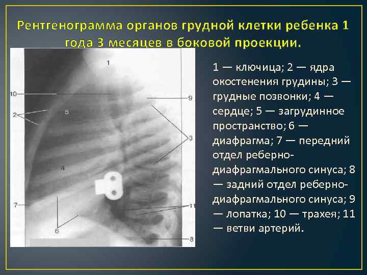 Рентгенограмма органов грудной клетки ребенка 1 года 3 месяцев в боковой проекции. 1 —