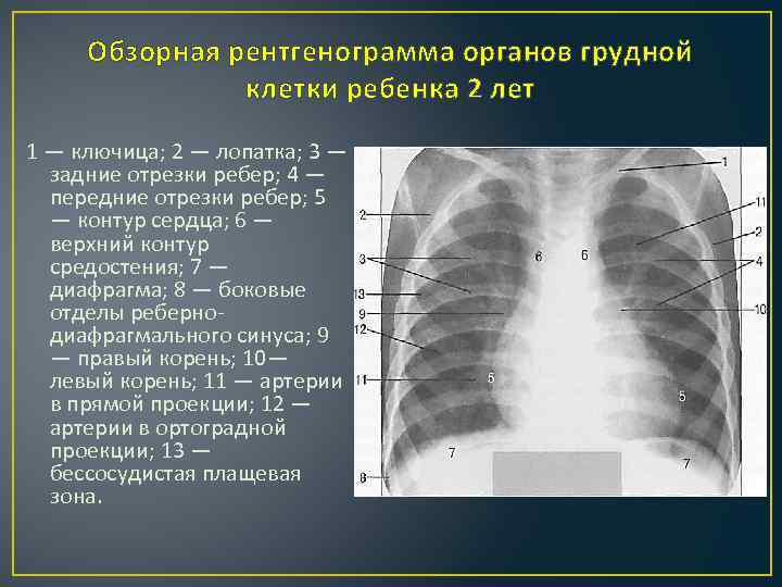 Обзорная рентгенограмма органов грудной клетки ребенка 2 лет 1 — ключица; 2 — лопатка;