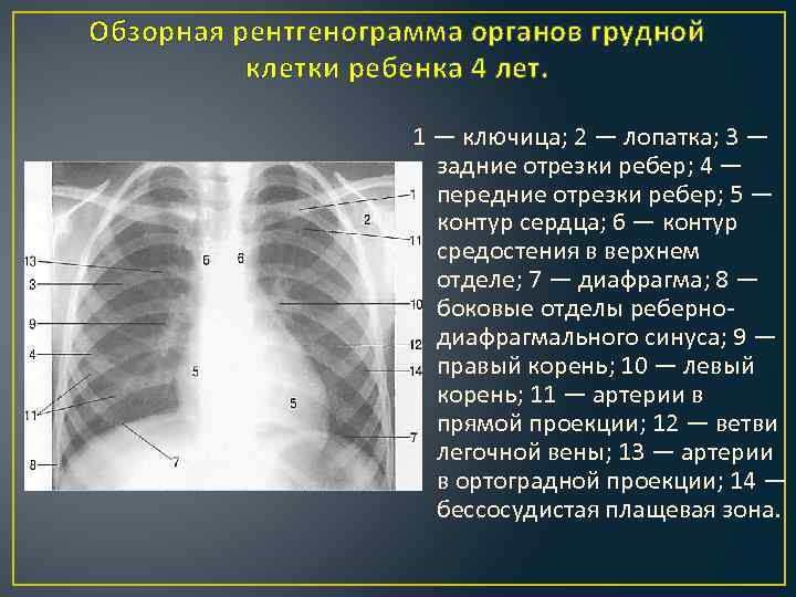 Обзорная рентгенограмма органов грудной клетки ребенка 4 лет. 1 — ключица; 2 — лопатка;