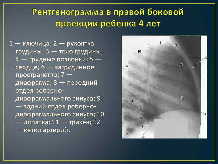 Рентгенограмма в боковой проекции. Рентгенограмма в правой боковой проекции. Грудина в боковой проекции. Грудные позвонки боковая проекция.